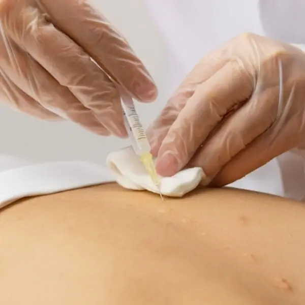 Procedimento de Terapia Neural com aplicação de anestésico local em baixa concentração na Clínica Corpo e Pele