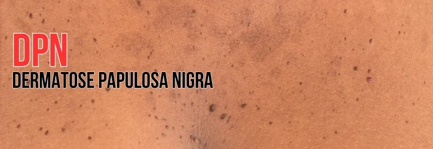 Dermatose Papulosa Nigra (DPN): Tratamento e Ozonioterapia