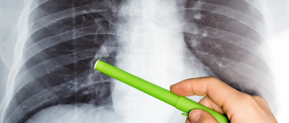 Fibrose Pulmonar - Os benefícios de se tratar com a ozonioterapia