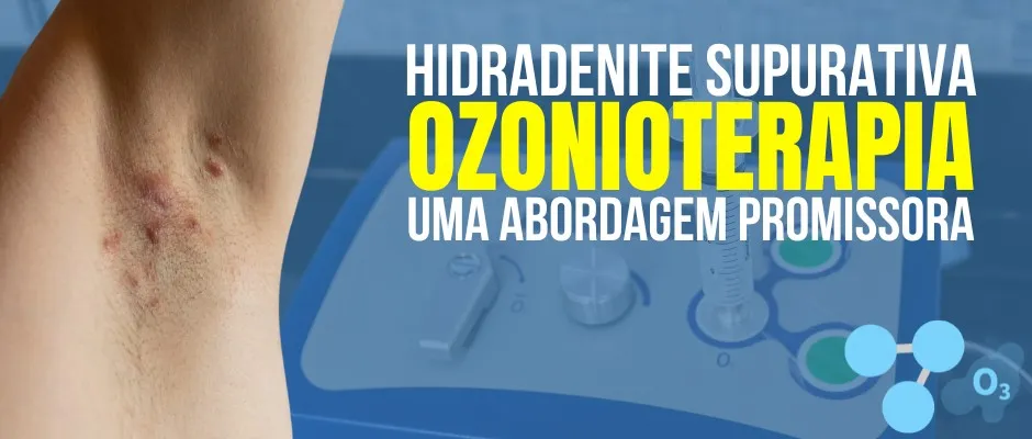 Ozonioterapia e Hidradenite Supurativa: uma aliança contra a dor e o estigma