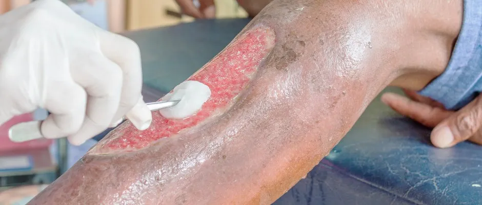 Escaras e Feridas Severas - Os benefícios de se tratar com a ozonioterapia