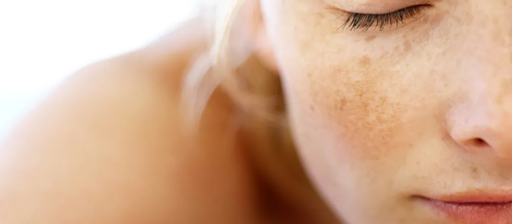 Melasma - Os benefícios de se tratar com a ozonioterapia