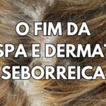 A Ozonioterapia tem sido uma ótima alternativa para Tratamento de Caspa e Dermatite Seborreica. Eliminação total de fungos, bactérias e vírus.
