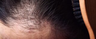 Alopecia e Calvicie