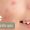 Tratamento de Acne com Ozonioterapia