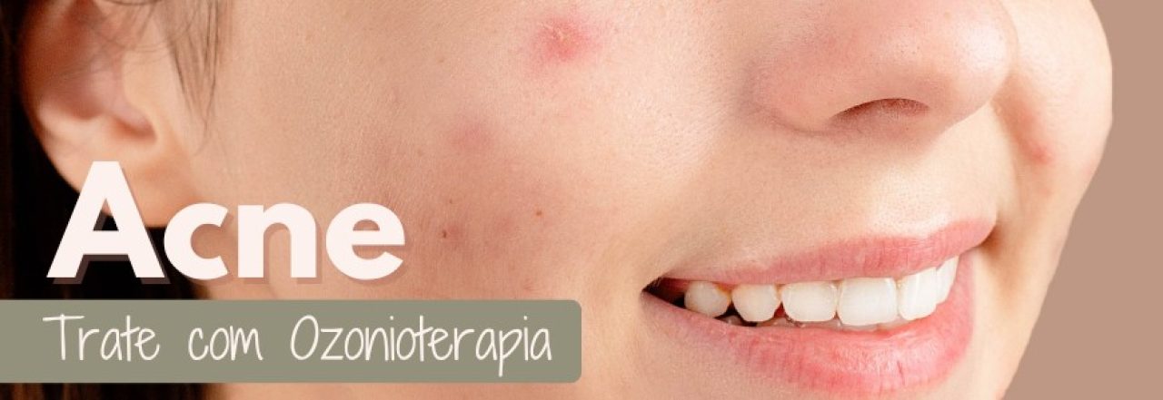 Tratamento de Acne com Ozonioterapia