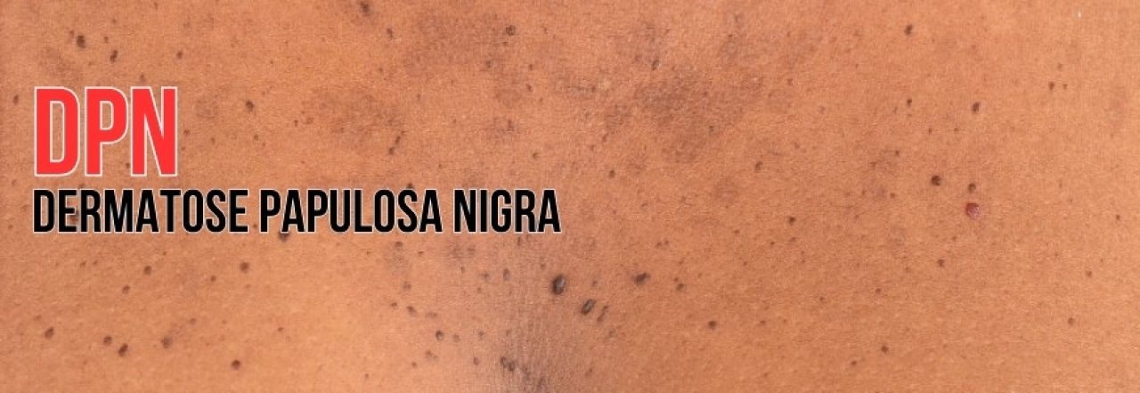 Dermatose Papulosa Nigra (DPN) - Os benefícios de se tratar com a ozonioterapia