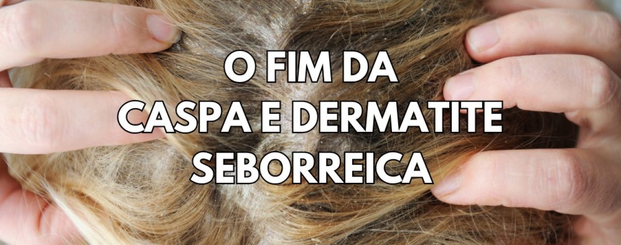 A Ozonioterapia tem sido uma ótima alternativa para Tratamento de Caspa e Dermatite Seborreica. Eliminação total de fungos, bactérias e vírus.