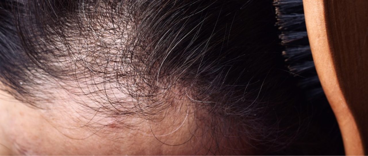 Alopecia e Calvicie