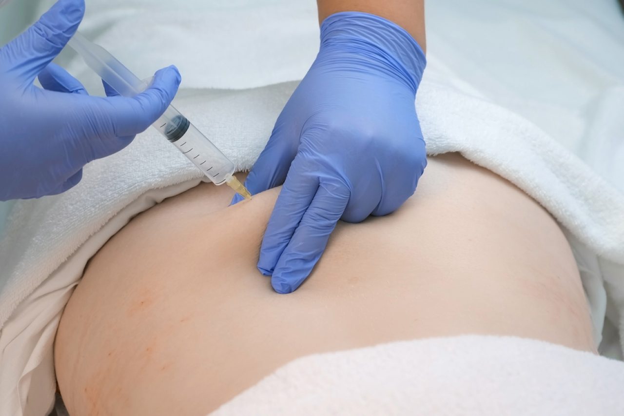Ozonioterapia
