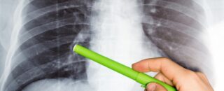 Fibrose Pulmonar - Os benefícios de se tratar com a ozonioterapia